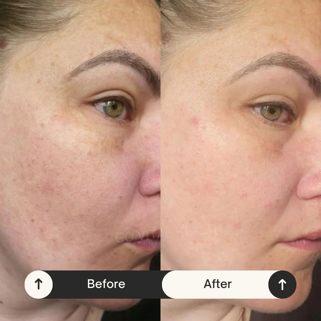 liveon testimonial before and after